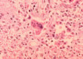 Pediatrician: Measles ‘will never go away’