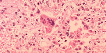 Pediatrician: Measles ‘will never go away’