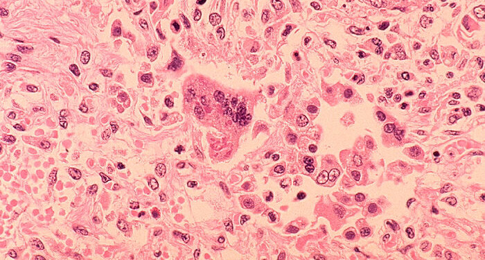 Pediatrician: Measles ‘will never go away’