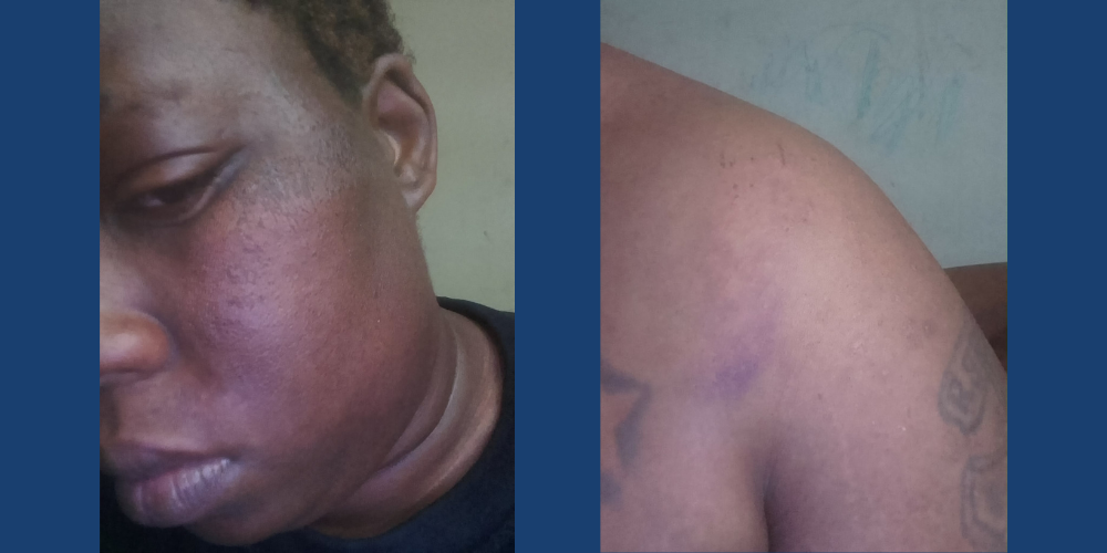 Bruising on a teen after an incident from Dan Jansen Family Fest in May 2026. Images courtesy of the Brown family.