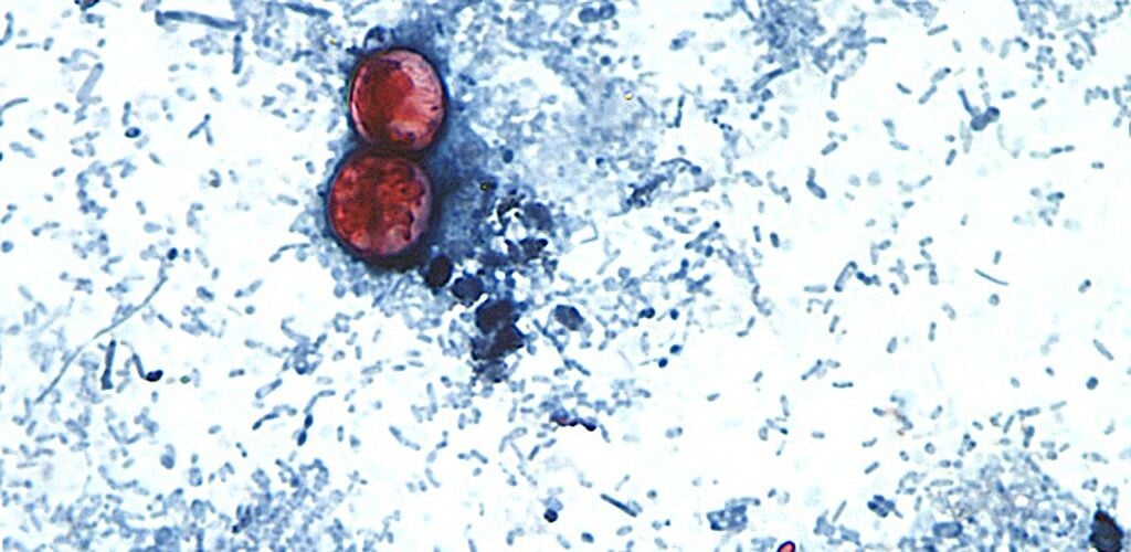 Michigan reports first 2 US deaths in outbreak of Cyclospora