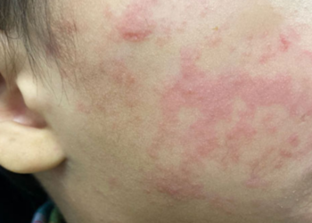 The child’s cheek shows the characteristic rash associated with measles. Image courtesy of the US Centers for Disease Control and Prevention.