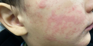 The child’s cheek shows the characteristic rash associated with measles. Image courtesy of the US Centers for Disease Control and Prevention.