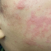 The child’s cheek shows the characteristic rash associated with measles. Image courtesy of the US Centers for Disease Control and Prevention.