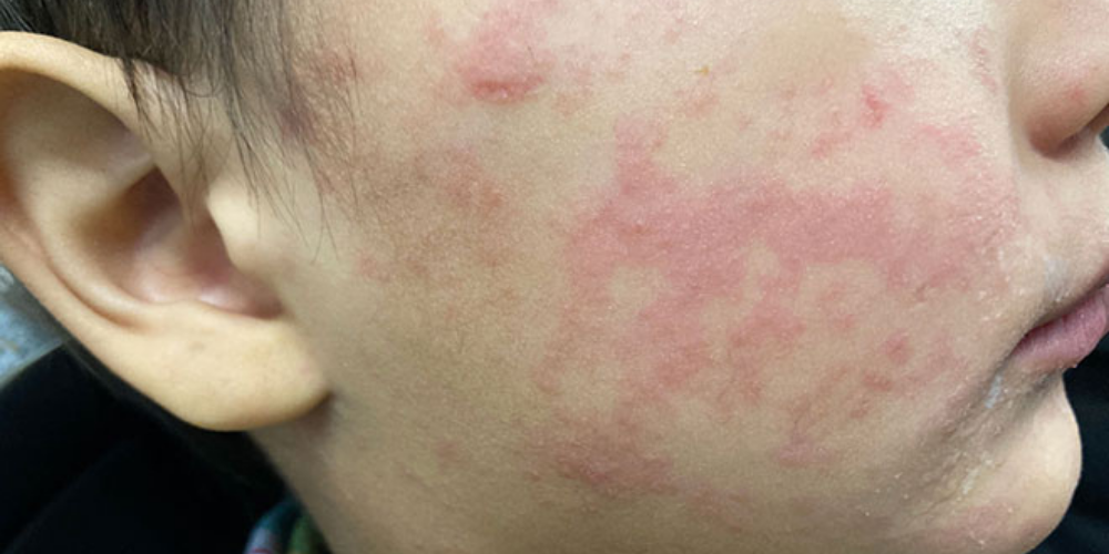 Total confirmed measles cases in Wisconsin surpasses 100
