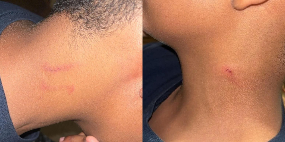 Injuries to Trowbridge Street School student on September 15, 2026. Images courtesy of Amaday Rodriguez.