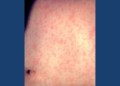 Skin of a patient after three days with measles rash. Image courtesy of the US Centers for Disease Control and Prevention.