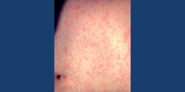Skin of a patient after three days with measles rash. Image courtesy of the US Centers for Disease Control and Prevention.