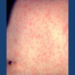 Skin of a patient after three days with measles rash. Image courtesy of the US Centers for Disease Control and Prevention.